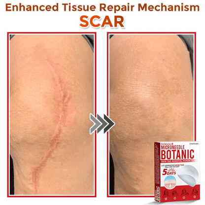 💥Solaroza® MicroNeedle Botanic Skin Patch – Safe & Effective against Skin Tags, Warts & Moles! ✨ Limited time only: Save 80% now (USA).