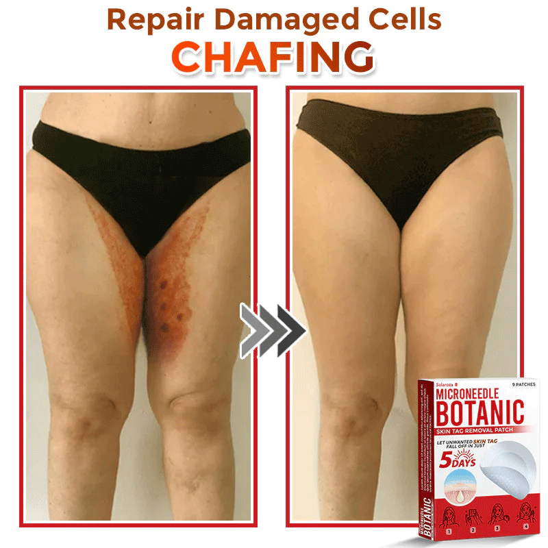 💥Solaroza® MicroNeedle Botanic Skin Patch – Safe & Effective against Skin Tags, Warts & Moles! ✨ Limited time only: Save 80% now (USA).