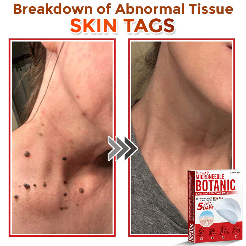 💥Solaroza® MicroNeedle Botanic Skin Patch – Safe & Effective against Skin Tags, Warts & Moles! ✨ Limited time only: Save 80% now (USA).