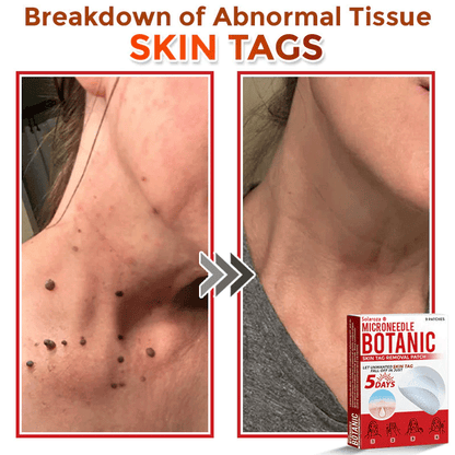 💥Solaroza® MicroNeedle Botanic Skin Patch – Safe & Effective against Skin Tags, Warts & Moles! ✨ Limited time only: Save 80% now (USA).
