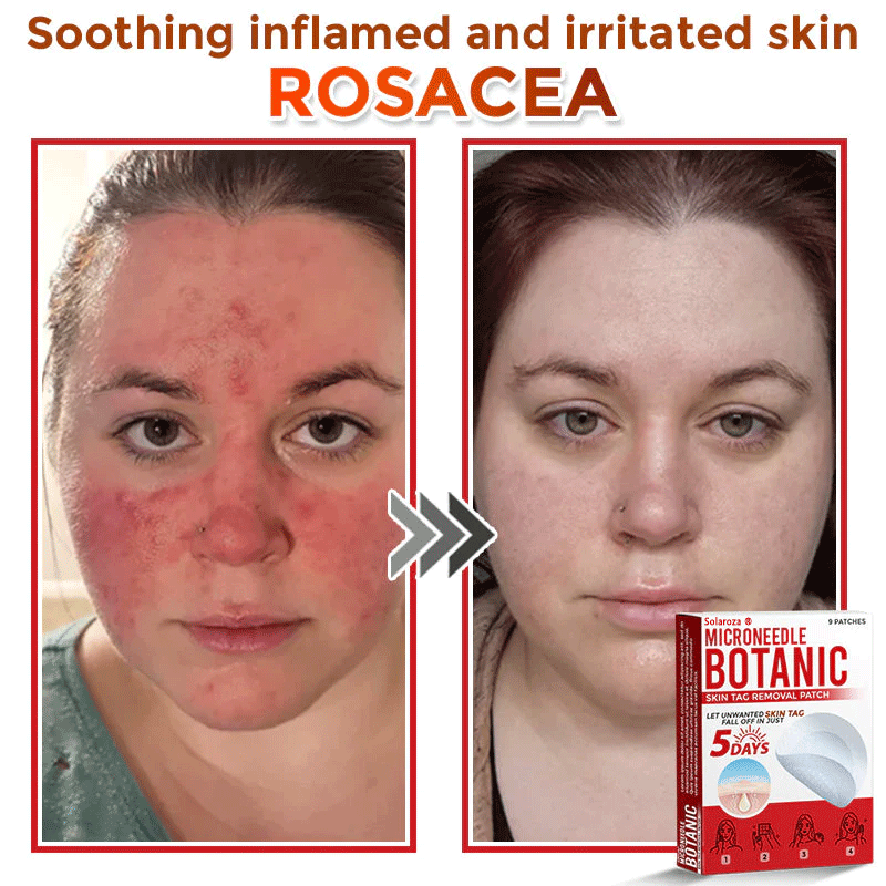 💥Solaroza® MicroNeedle Botanic Skin Patch – Safe & Effective against Skin Tags, Warts & Moles! ✨ Limited time only: Save 80% now (USA).