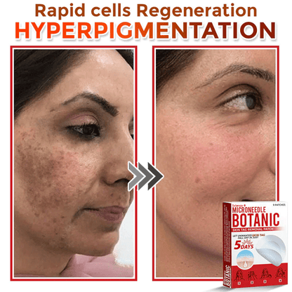 💥Solaroza® MicroNeedle Botanic Skin Patch – Safe & Effective against Skin Tags, Warts & Moles! ✨ Limited time only: Save 80% now (USA).