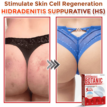 💥Solaroza® MicroNeedle Botanic Skin Patch – Safe & Effective against Skin Tags, Warts & Moles! ✨ Limited time only: Save 80% now (USA).