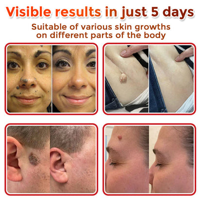 💥Solaroza® MicroNeedle Botanic Skin Patch – Safe & Effective against Skin Tags, Warts & Moles! ✨ Limited time only: Save 80% now (USA).